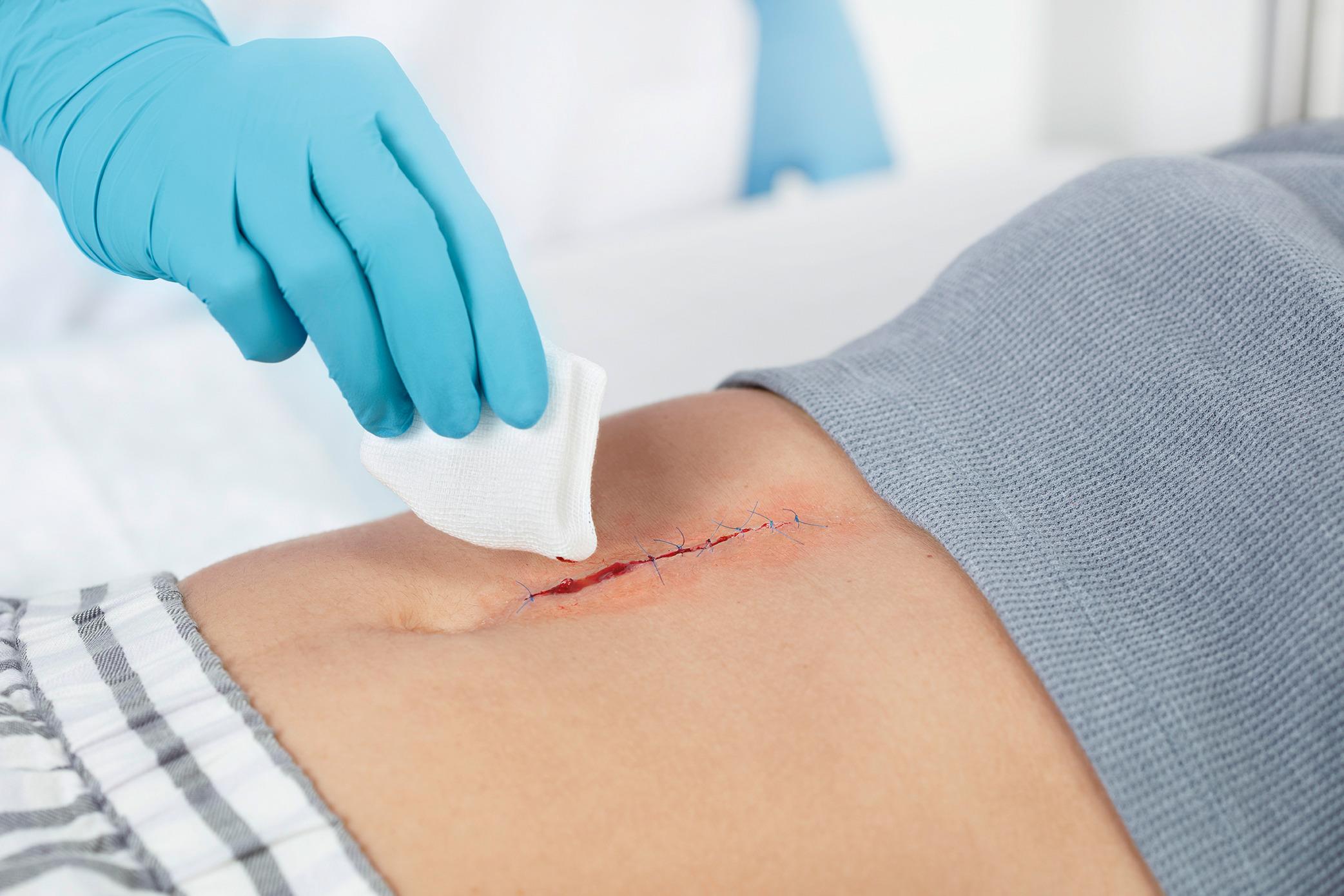 Leukoplast compress cotton gauze unsteril PK 100 7,5 x 7,5cm 8fach