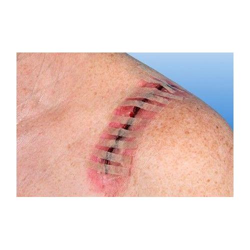 NOBA VERBANDMITTEL DANZ Rudanaht 6 x 38mm PK 50x6 Wundnahtstreifen, hautfarben